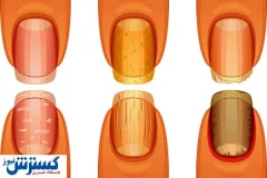 تشخیص سرطان ریه از روی ناخن ممکن شد