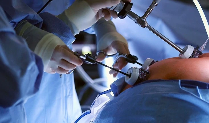 اسلیو معده اقساطی