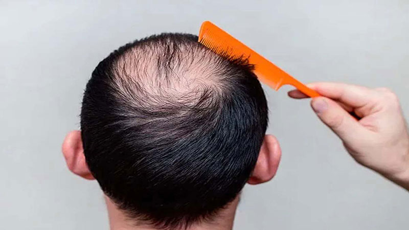 جدیدترین تکنیکهای کاشت مو در سال ۱۴۰۴ بهترین دکتر کاشت مو در تهران