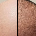 جدیدترین تکنیک‌های کاشت مو در سال ۱۴۰۴