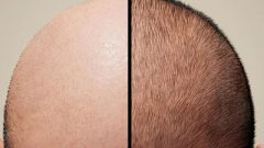 جدیدترین تکنیک‌های کاشت مو در سال ۱۴۰۴