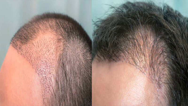 جدیدترین تکنیکهای کاشت مو در سال ۱۴۰۴ بانک مو