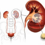 علائم سنگ کلیه، جدیدترین روش‌های درمان و پیشگیری