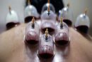 حجامت توسط افراد غیر متخصص خطرناک است